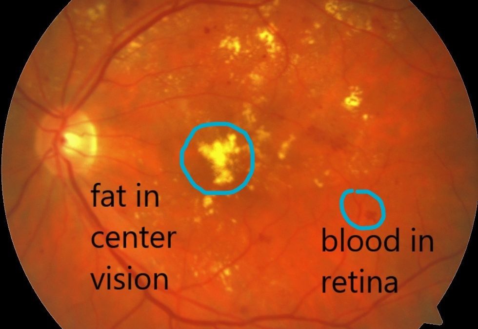 Diabetic retinopathy macular edema