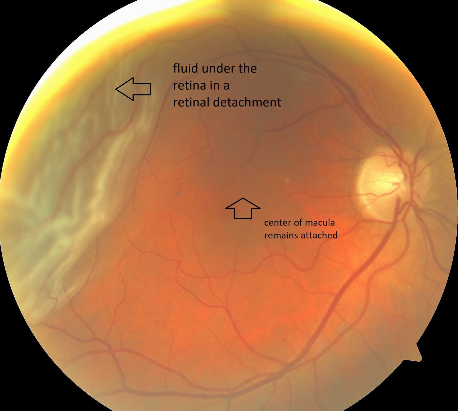 detached retina treatment