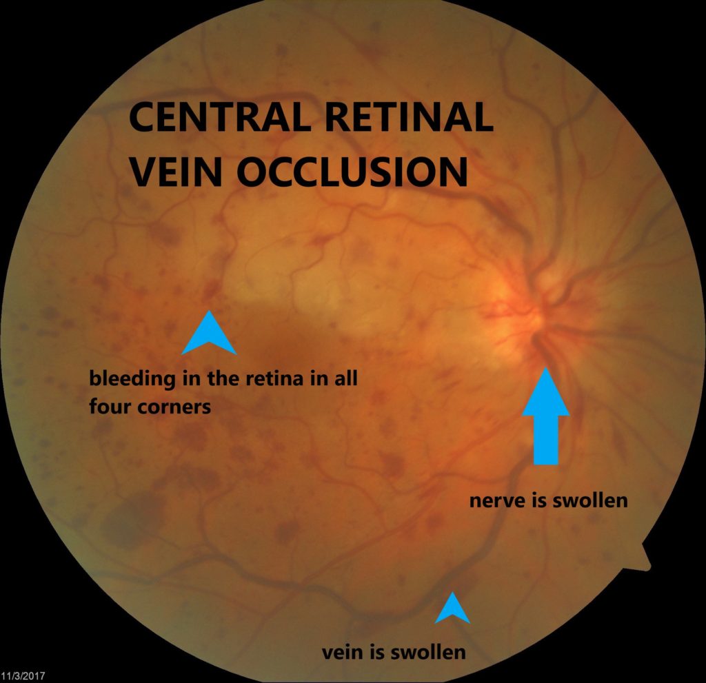 band around eye after retina surgery